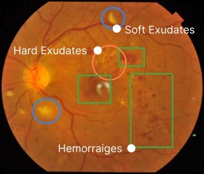 Realtime interactive fundus analysis with highlighted findings